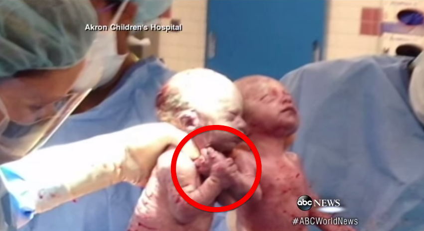 手を繋いで産まれてきた双子