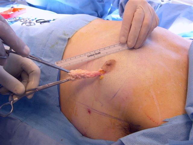 Gynecomastia Surgery Cost