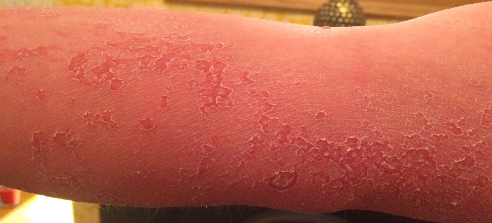 My pityriasis rubra pilaris blog March 2015