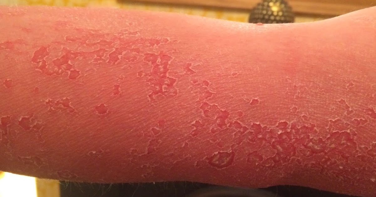 My pityriasis rubra pilaris blog Broken skin rash