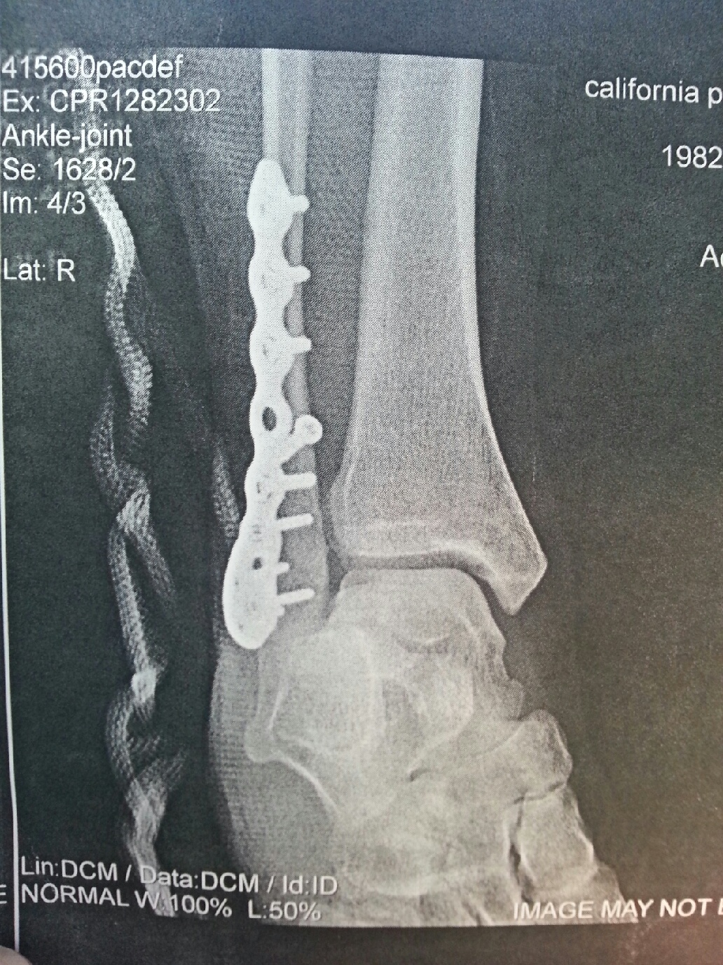 My Broken Ankle =( New Fiberglass Cast