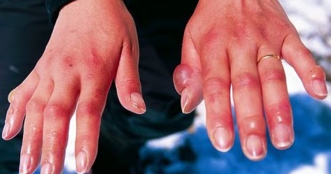 Gangrene and your body health ~ Health Tips & Alert