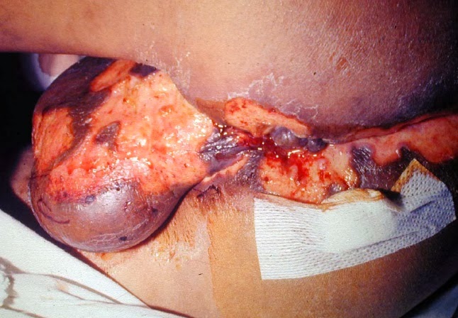 Ciri Ciri Aids Ciri Ciri Penyakit Hiv Aids | Holidays OO