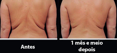 Tratamento para perder gordura nas costas: Criolipólise Antes e depois de criolipólise nas costas e flancos