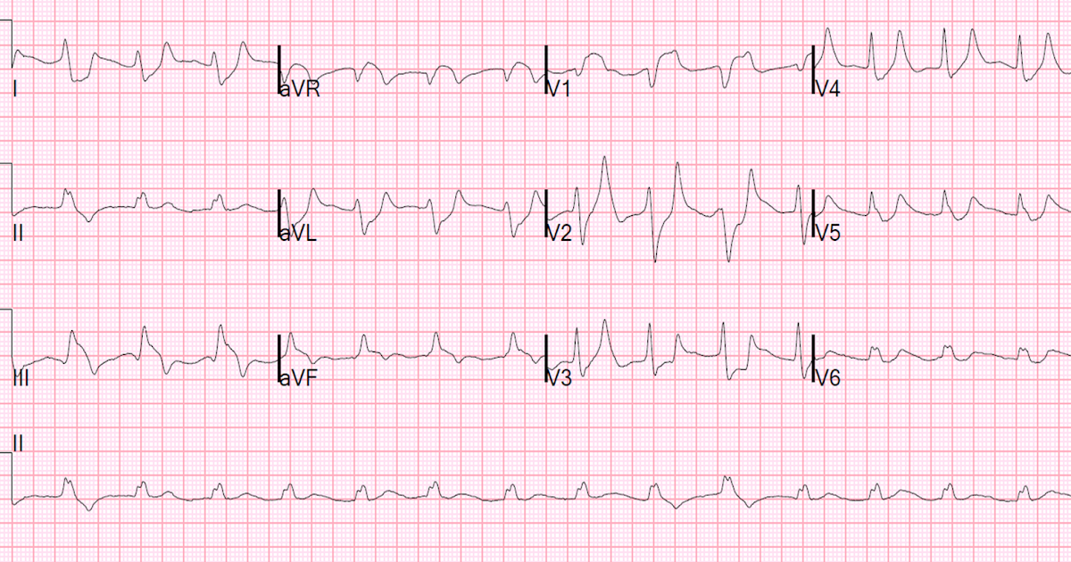 hyperkalemia ecg changes hyperkalemia ecg changes