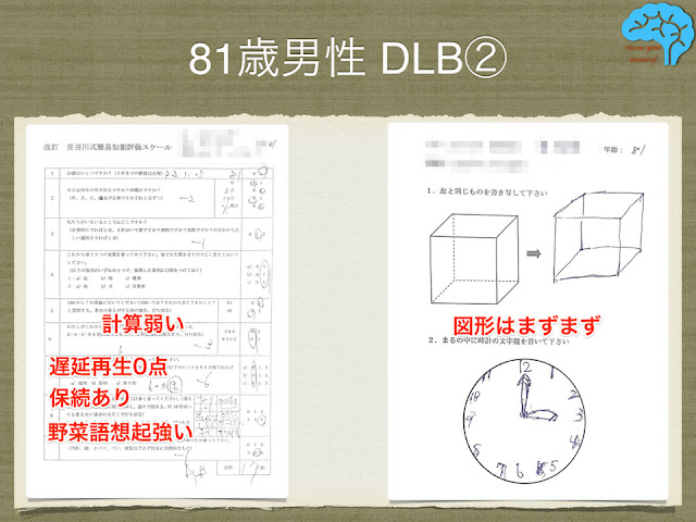 81歳男性DLBの長谷川式と時計描画テスト