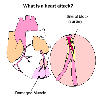 heart attack symptoms