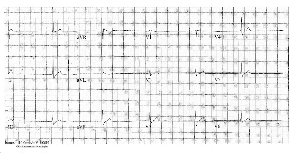 ECG of the Week ECG of the Week 11th June 2012 Interpretation
