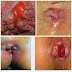 Obat Ambeien Wasir Secara Alami thumbnail