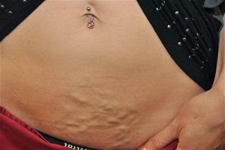 Varices En El Abdomen Varices En El Abdomen