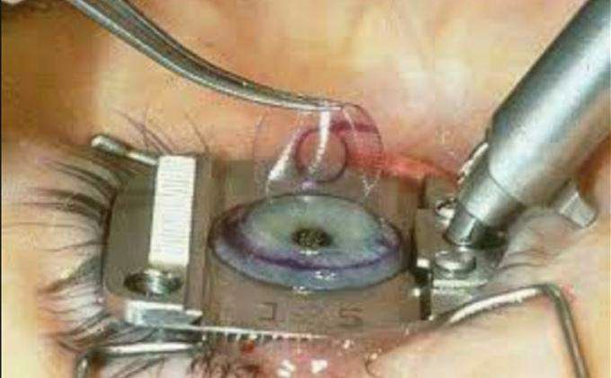 Dr. OZ Indonesia Operasi Lasik Dr. OZ Indonesia Operasi Lasik