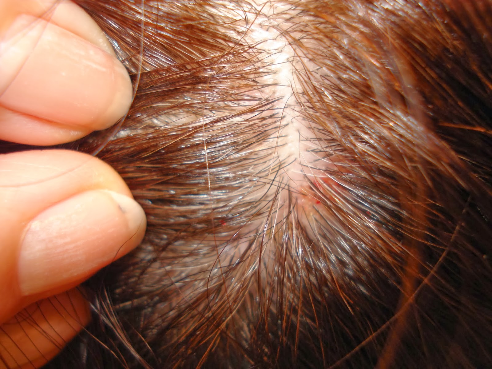 Accutane Itchy Scalp Hair Loss Ciprofloxacino Staphylococcus Aureus