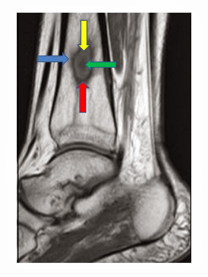Dental Abscess Osteomyelitis at Lisa Barton blog