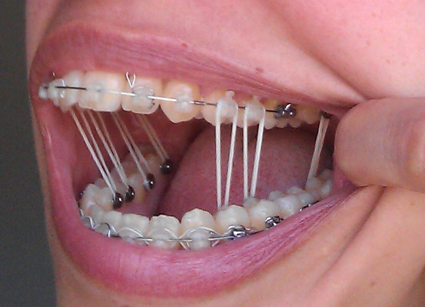 My Damon Clear Braces March 2014