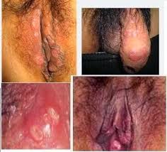 gambar sipilis wanita