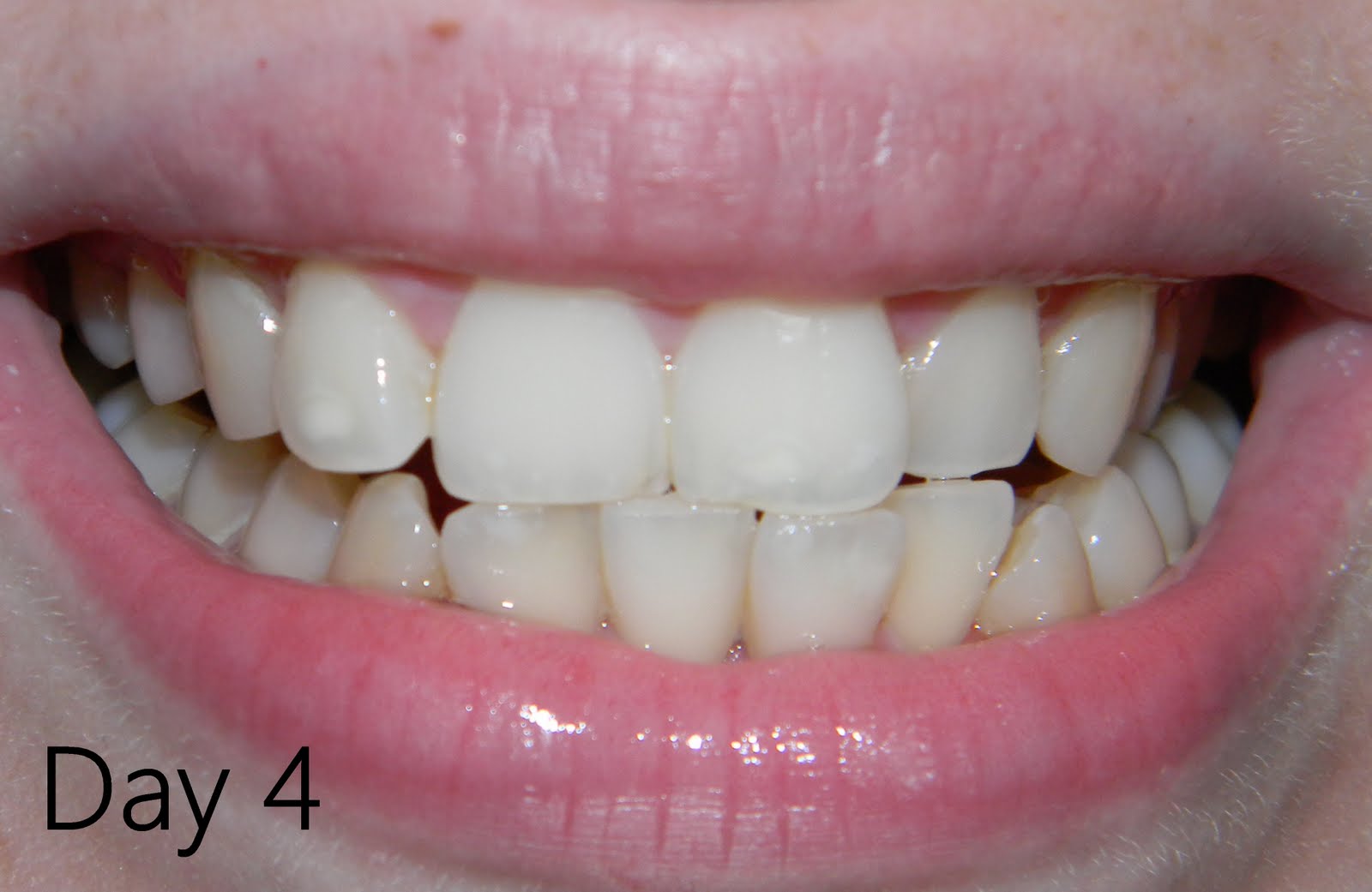 MissBudgetBeauty Crest Whitestrips Review