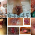 Terapi Ambeien dengan Obat Herbal Ambeclear thumbnail