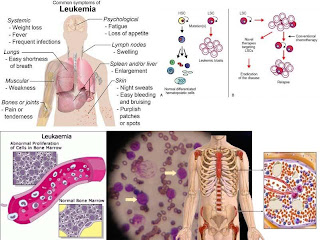 Leukemia.jpg