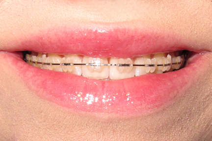 Before And After Pics Of Braces. efore and after braces