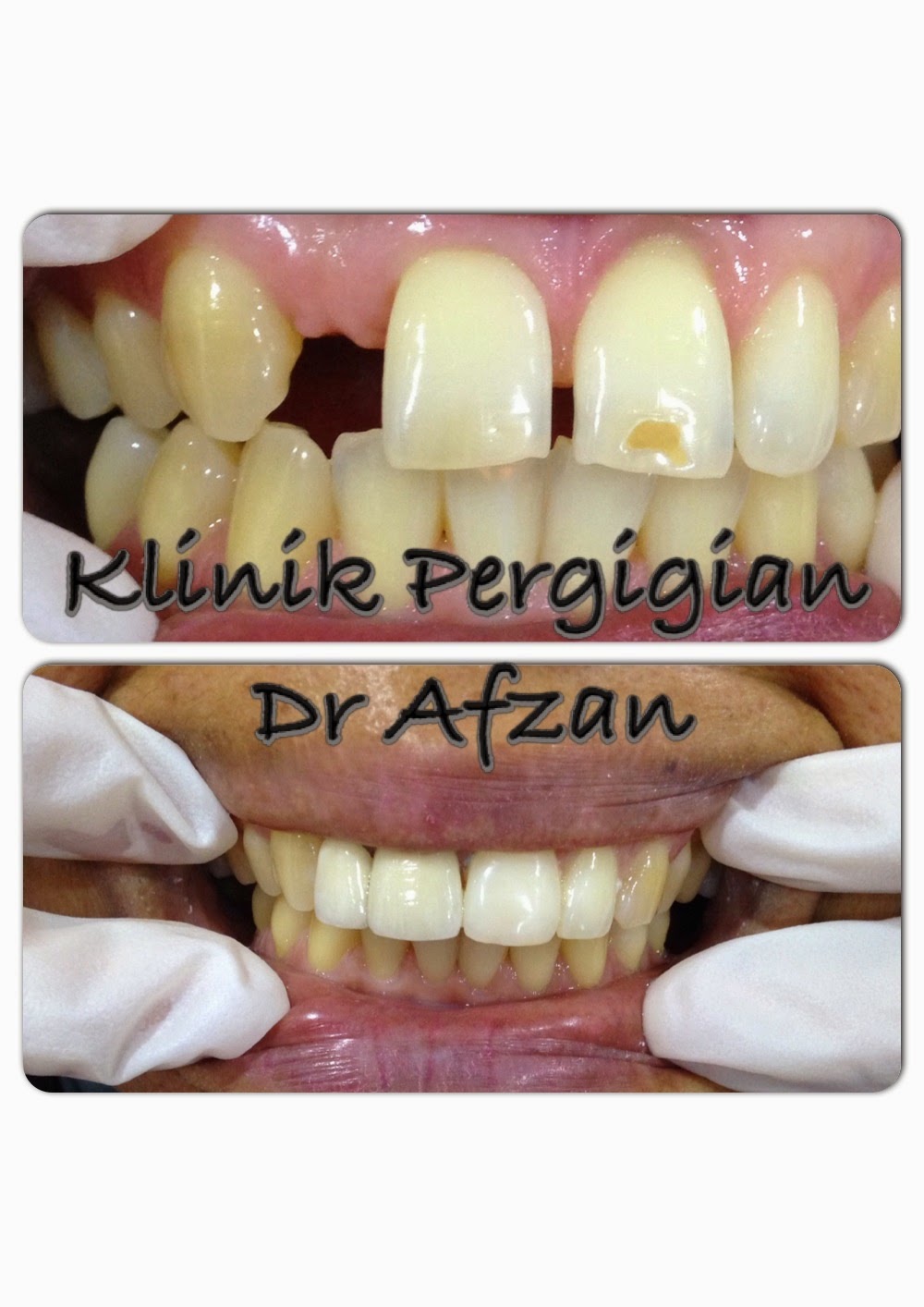 Your Family Dentist Jambatan Gigi Dental Bridge