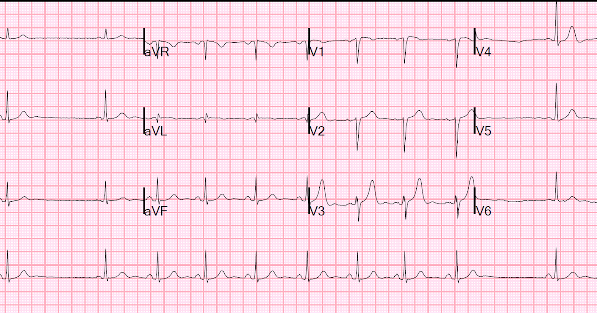 Dr. Smith's ECG Blog Two interrupted sinus beats. What is the etiology?