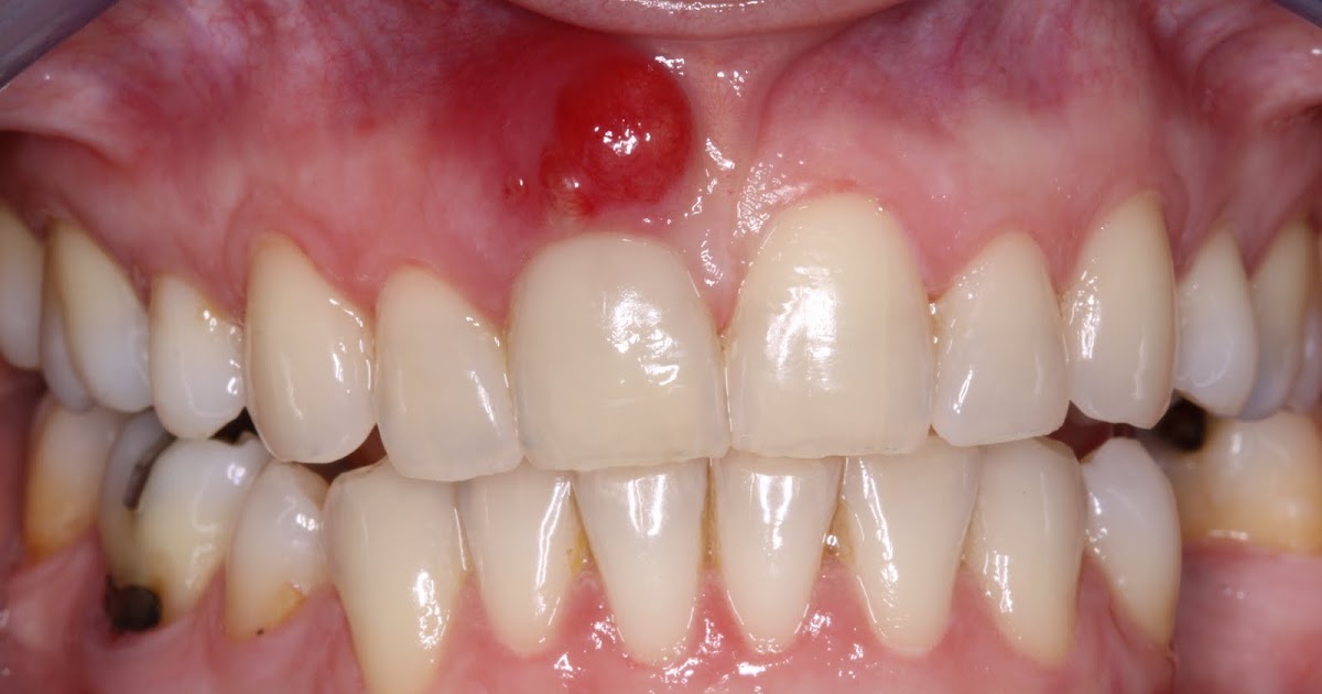 www.BestOgdenDentist.com Blog: What is a tooth abscess?