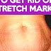 Stretch Marks - Best Way To Get Rid Of Stretch Marks On Thighs