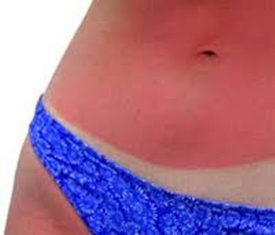 Uv Rash From Tanning Bed Uv Rash From Tanning Bed