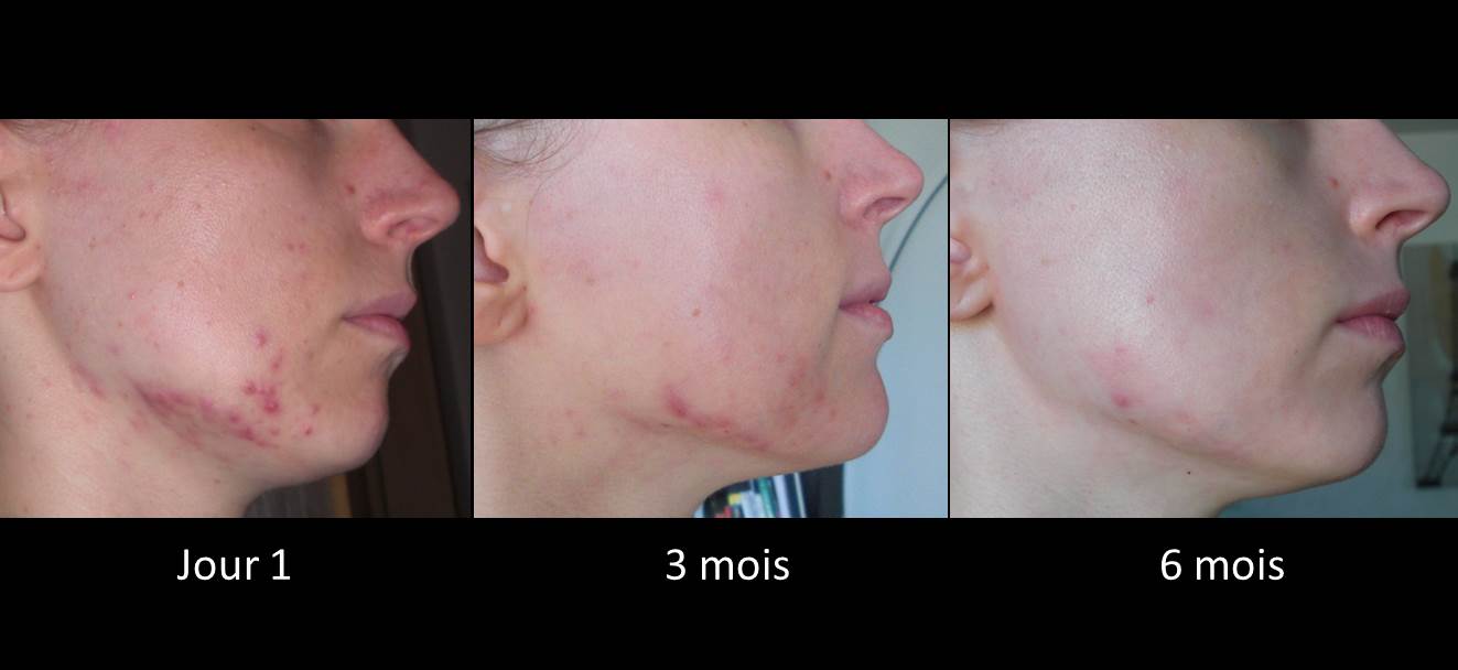 Roaccutane, à l'aube de mes 30 ans: juin 2014