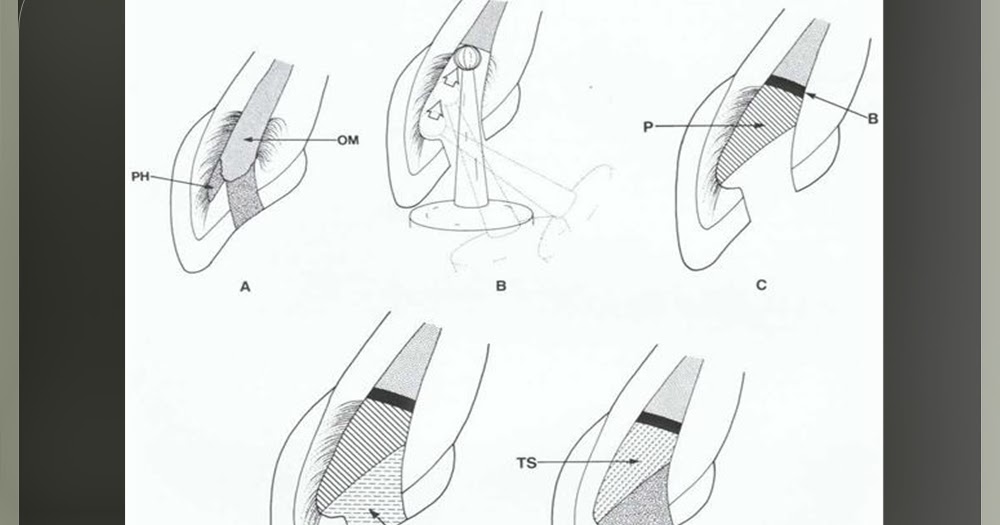DOs and DONTs in DENTISTRY WALKING BLEACH TECHNIQUE