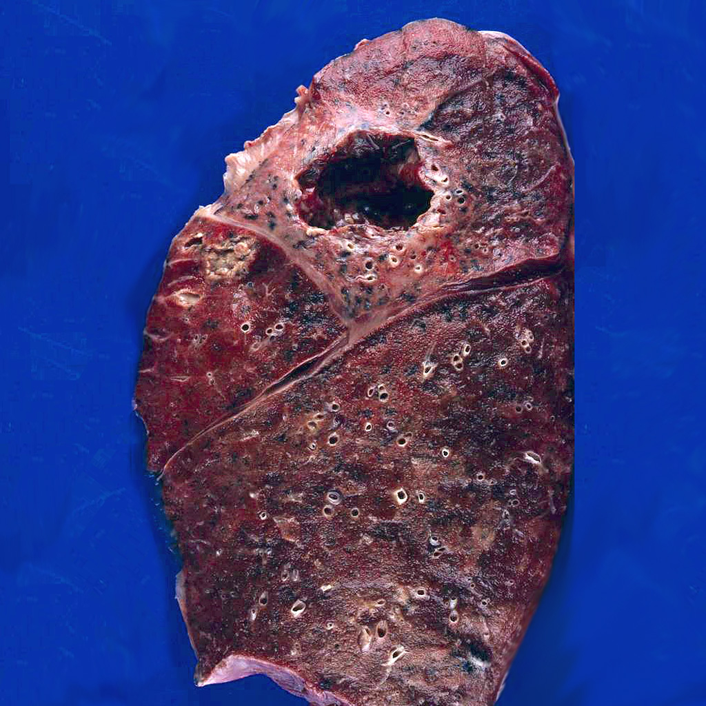 Small cell carcinoma