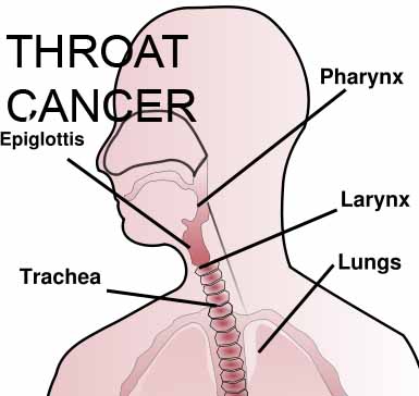 throat cancer stage larynx symptoms areas pharyngeal voice blabber bio box health