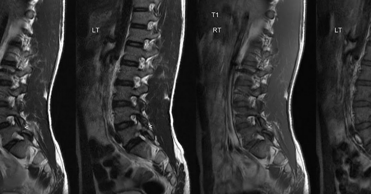 Neuroradiology Cases Spondylolysis