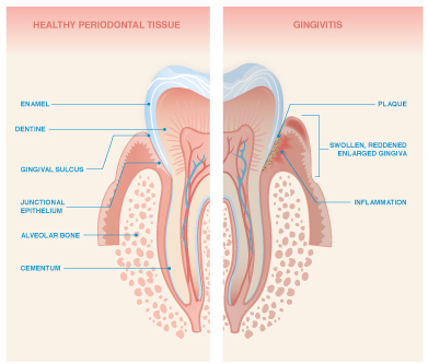 Gingivitis Treatment