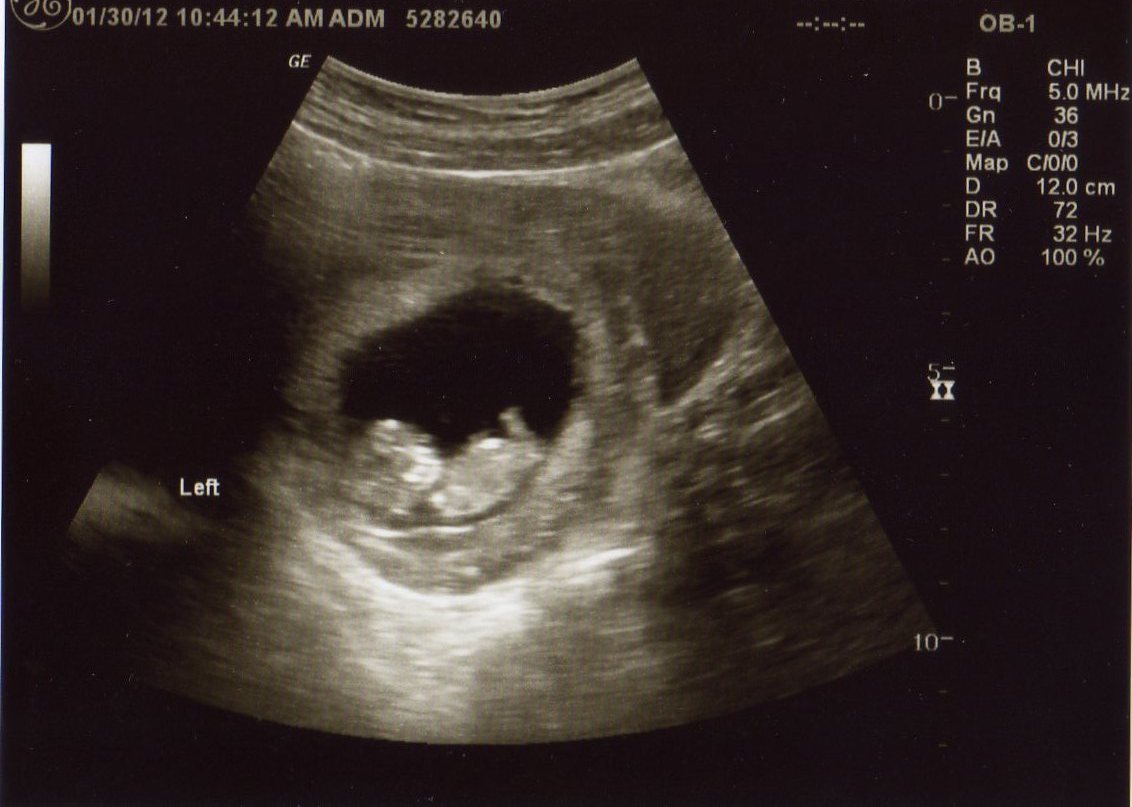 Miracles On Long View Drive: Ultrasound Pics