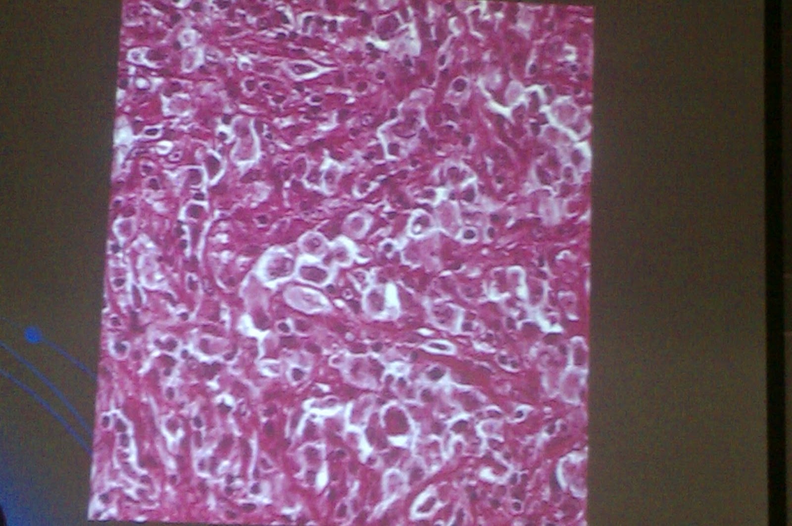 hodgkins lymphoma research paper hodgkins lymphoma research paper