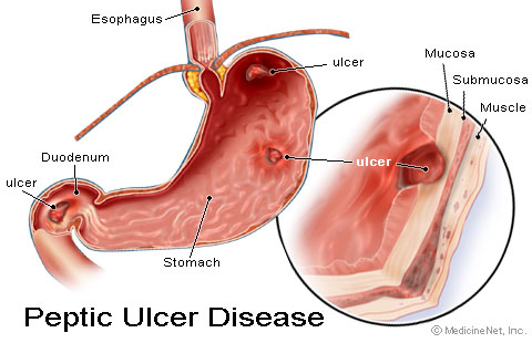 Gastric Ulcer Otc Medication