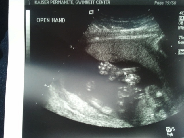 Baby Wilcox and the Journey of Getting Pregnant: 20 weeks 5 months