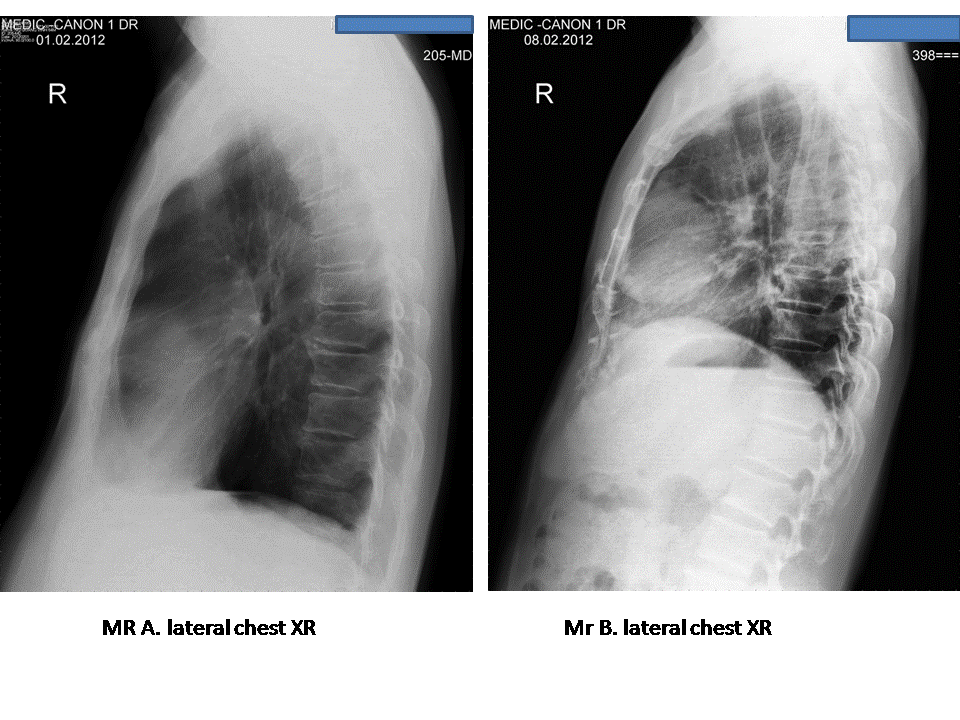 VIETNAMESE MEDIC ULTRASOUND CASE 188 MEDIC RADIOLOGY CASE 5 THYMOMA