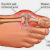 Eliminate gout, arthritis and fibromyalgia pain FAST with 3 natural home remedies