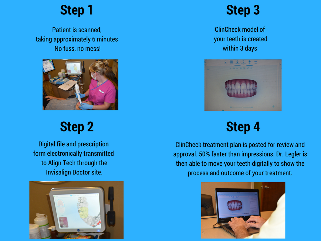 Legler Orthodontics iTero Element Digital Scanner Versus Impressions