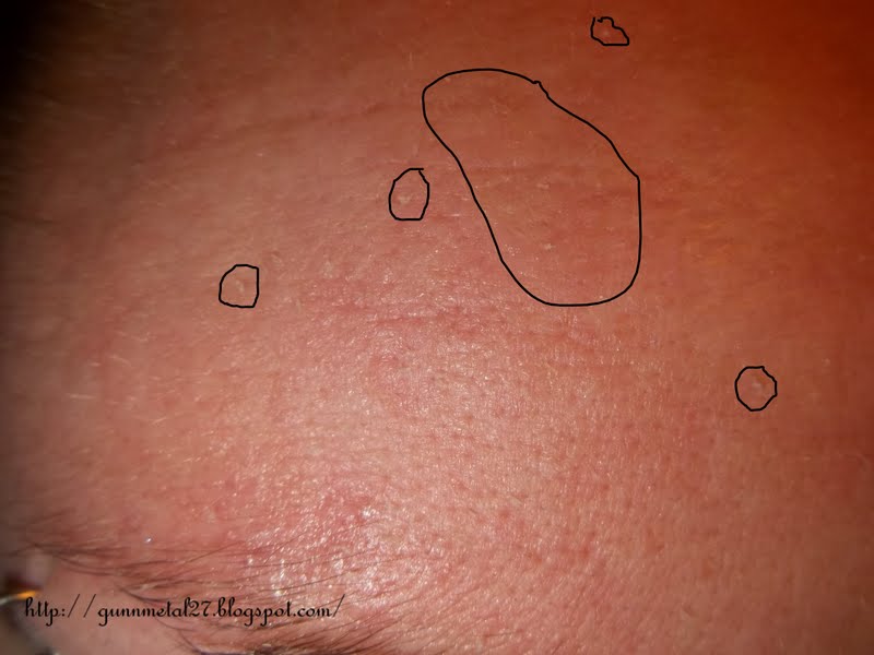 Small Dry Patch Skin Face