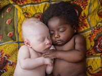 Kehidupan Mengerikan Penderita Albino Di Afrika