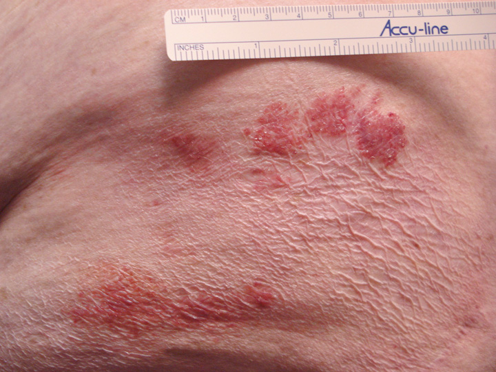 Forum on this topic: Fluocinonide, fluocinonide/ Forum on this topic: Fluocinonide, fluocinonide/
