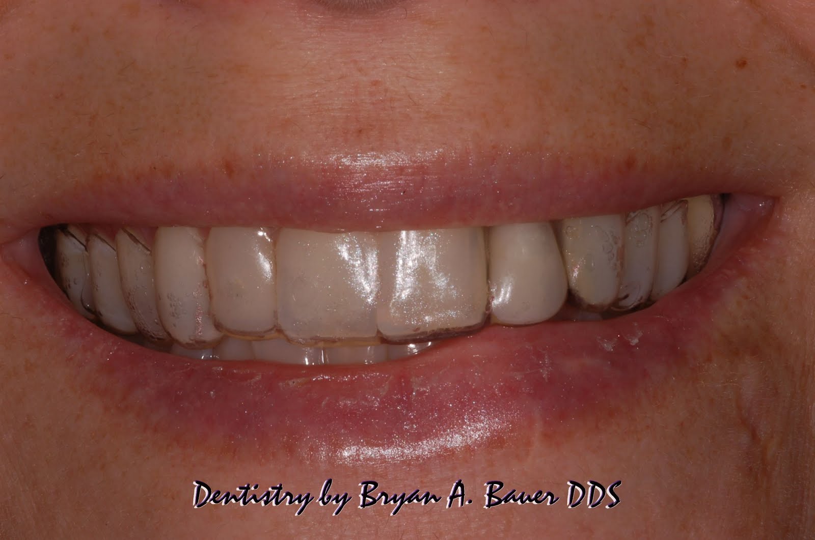 Dental flipper choices What are your options? What's cost?