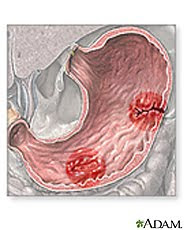 Ulcer Symptom