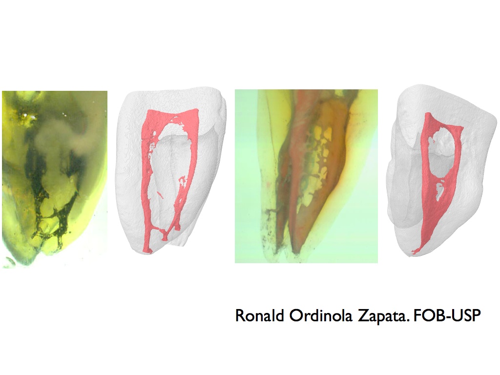 Apical Surgery for Complete Endodontic Healing Bridgers Blog