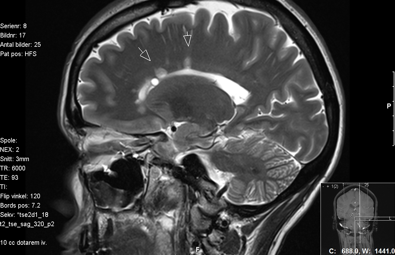 radiology mri proton density in multiple sclerosis
