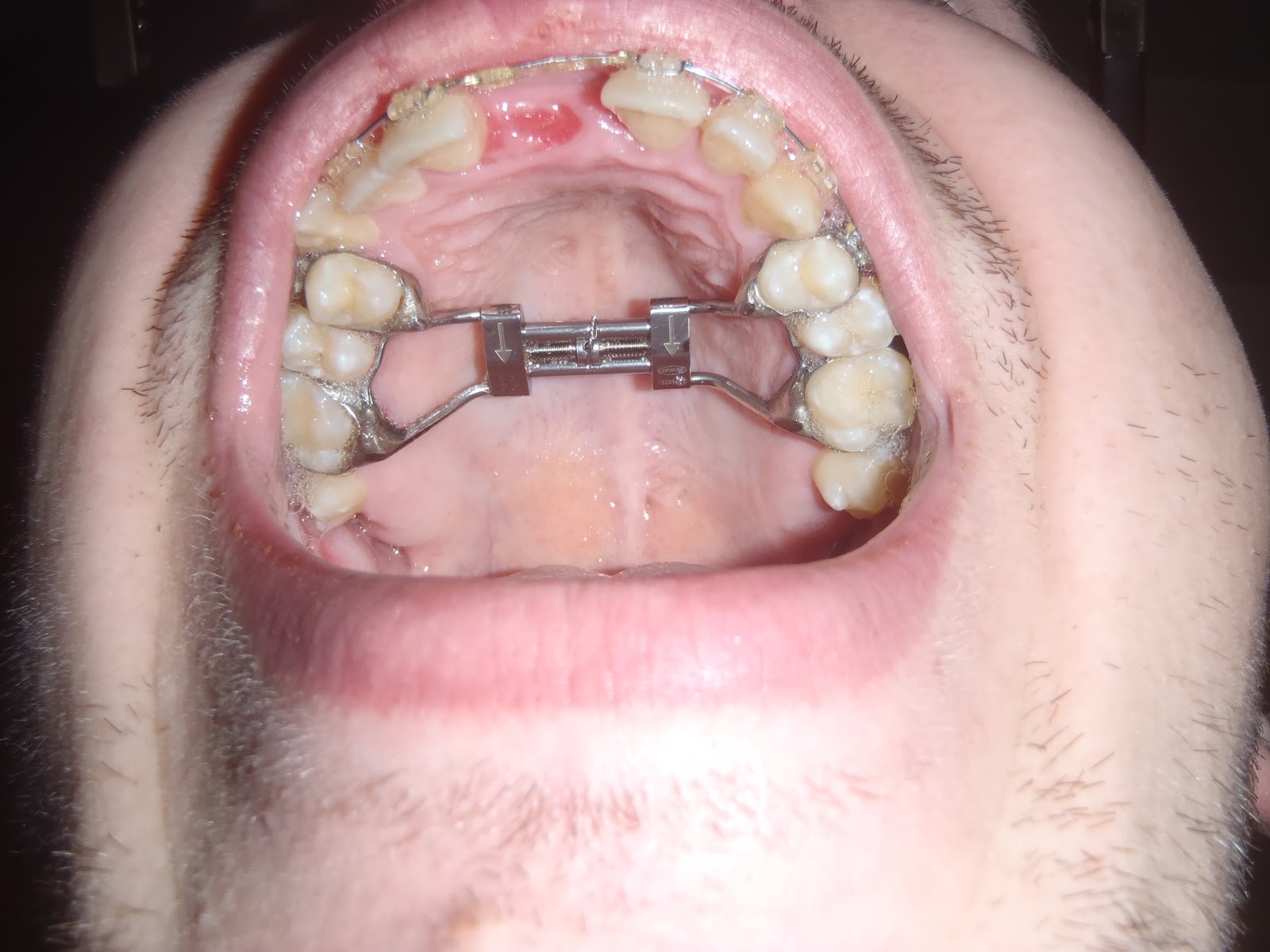 My SARPE Story Stalemate Braces vs The Expander!