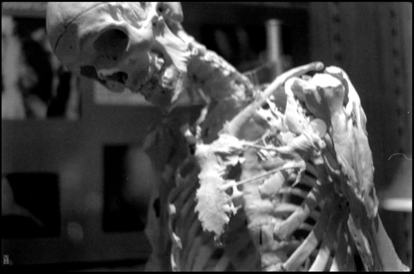 Rare Disorder What is Fibrodysplasia Ossificans